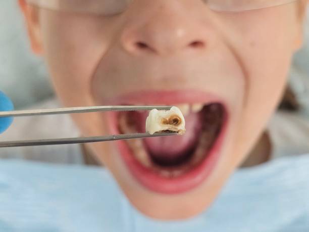 Best Chipped Tooth Repair Near Me  in Dennison, OH